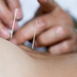 Les Suisses continueront de participer au financement de l'acupuncture via l'assurance de base (archives). KEYSTONE/GAETAN BALLY